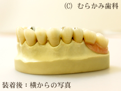 アタッチメントデンチャー:2