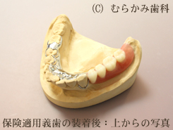 保険適用入れ歯:1