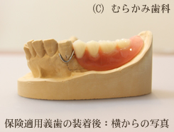 保険適用入れ歯:2