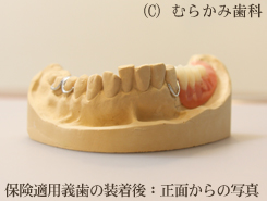 保険適用入れ歯:3