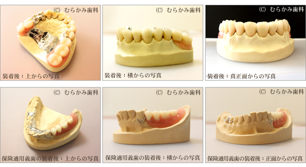 アタッチメントデンチャー（入れ歯・義歯）